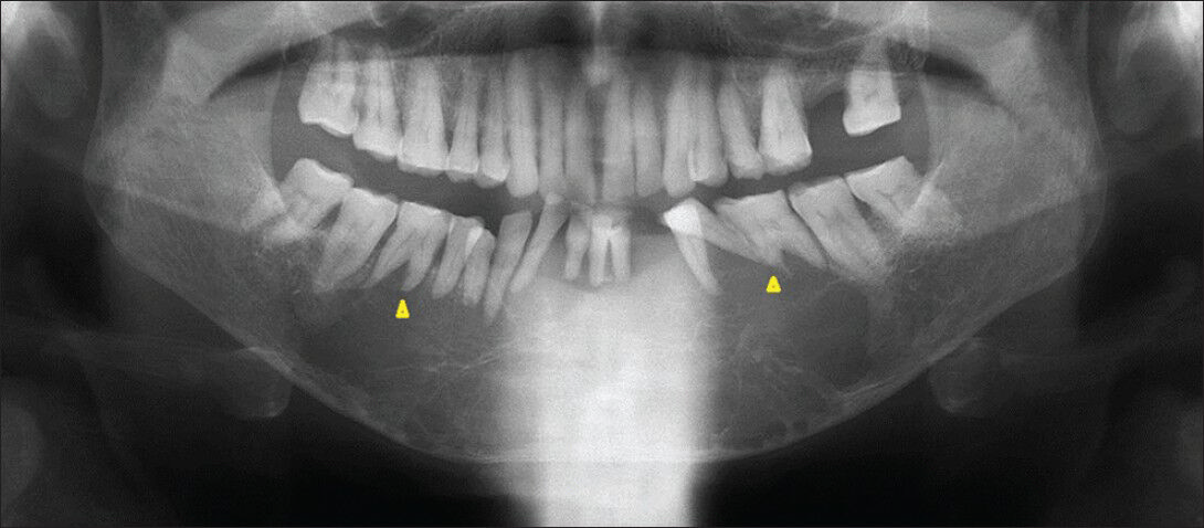 72-year-old male with a swelling in the mandible and the left lower leg, diagnosed with multiple myeloma. Conventional panoramic radiography reveals a multilocular radiolucency extending from 4 cm short of the right and the left angle of the mandible, across the midline, missing lower left canine, displacement of teeth, and resorption of the roots (arrowheads).